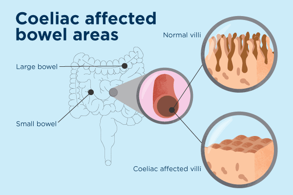 The Rise Of Coeliac Disease And The Need For Increased Knowledge On The